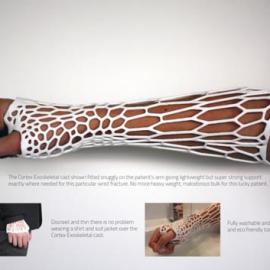 3D打印骨骼固定架