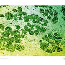 Krebsgesellschaft Nordrhein-Westfalen癌症协会广告