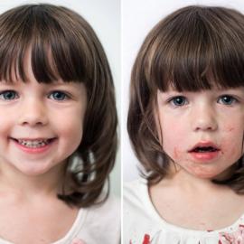 儿童在拔牙前后的状态